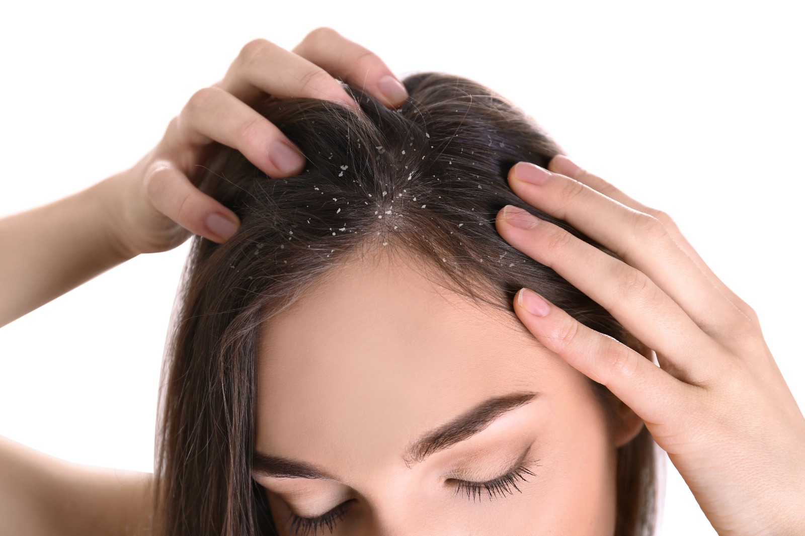 0 Dermatitis seborreica consenso