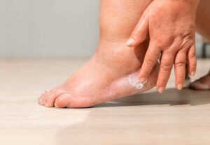 0 Día Mundial diabetes 2025 pie diabético