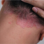 0 Manejo dermatitis seborreica