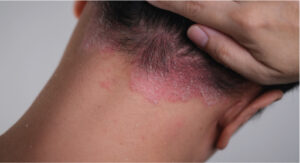 0 Manejo dermatitis seborreica