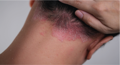 0 Manejo dermatitis seborreica