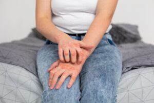 0 Psoriasis riesgo cardiovascular