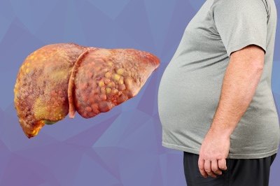 1 MASLD y diabetes
