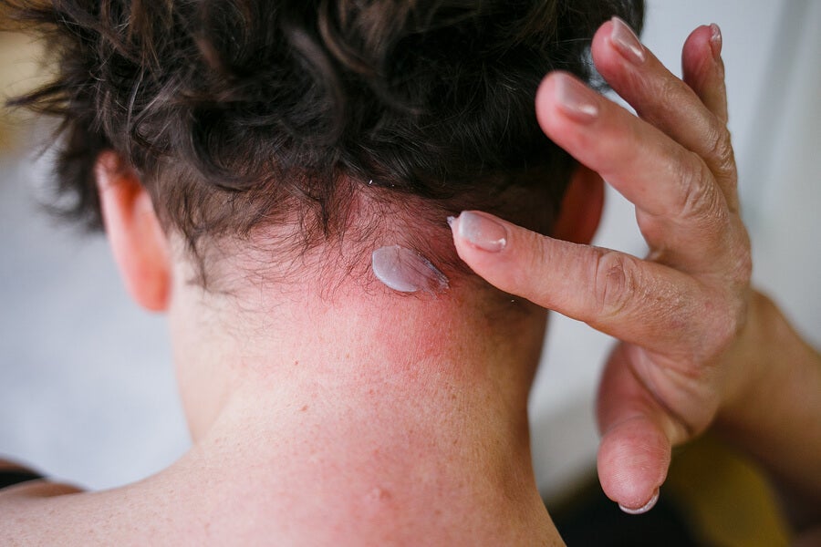 1 Manejo dermatitis seborreica
