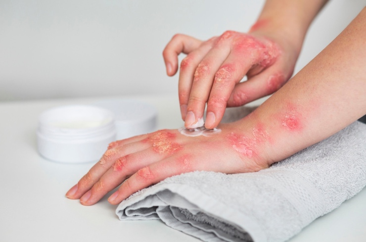 1 Psoriasis riesgo cardiovascular