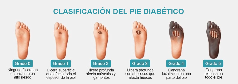 2 Día Mundial diabetes 2025 pie diabético