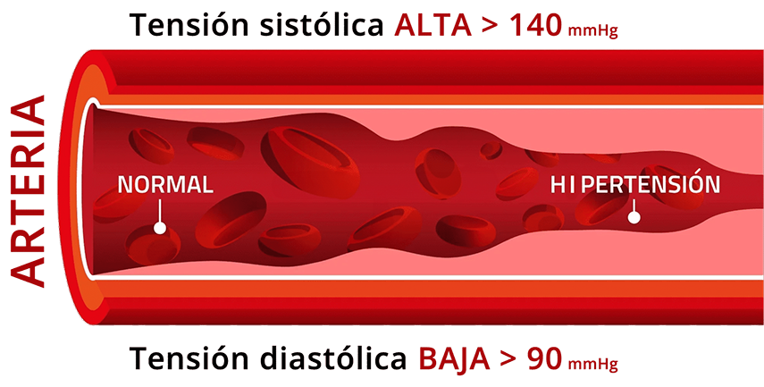 2 Día Mundial diabetes 2025 hipertensión