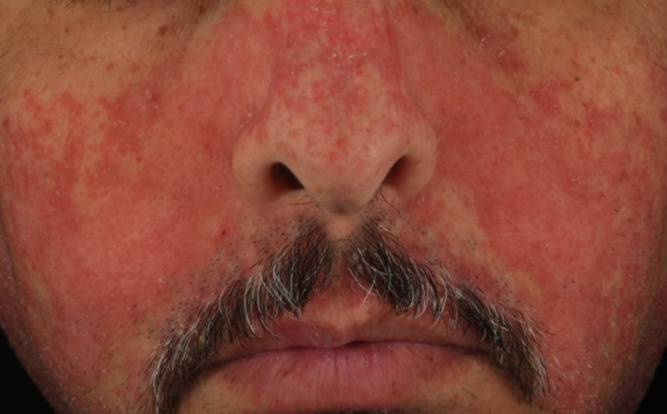 3 Manejo dermatitis seborreica