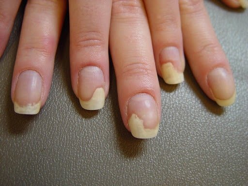 4 Diabetes uñas