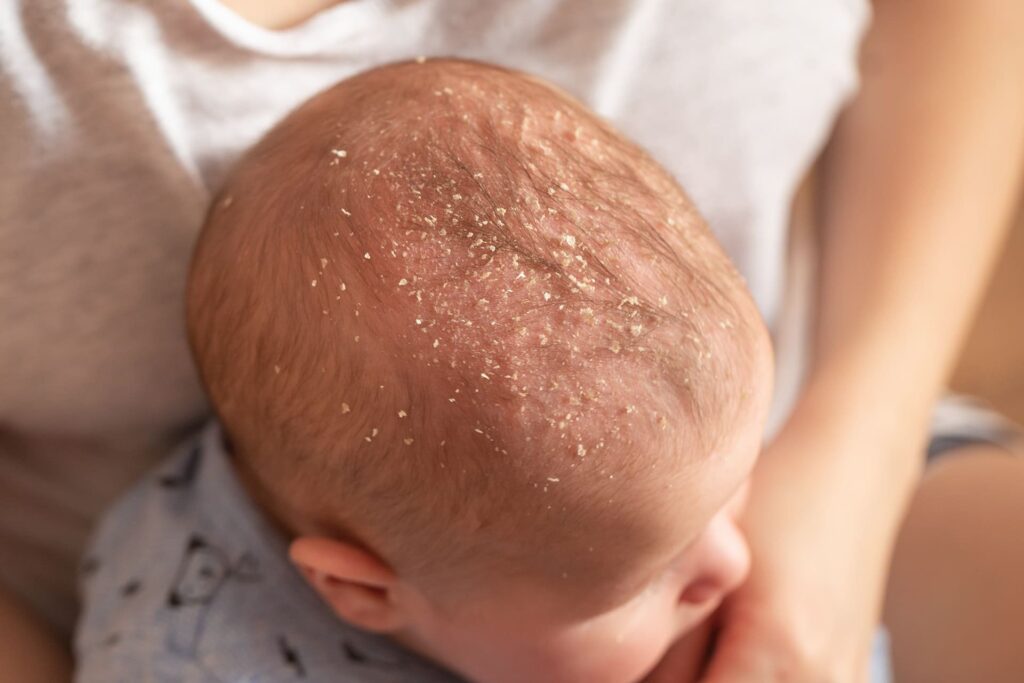 4 Manejo dermatitis seborreica