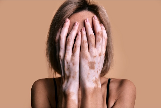 4 Vitiligo enfermedades cardiovasculares
