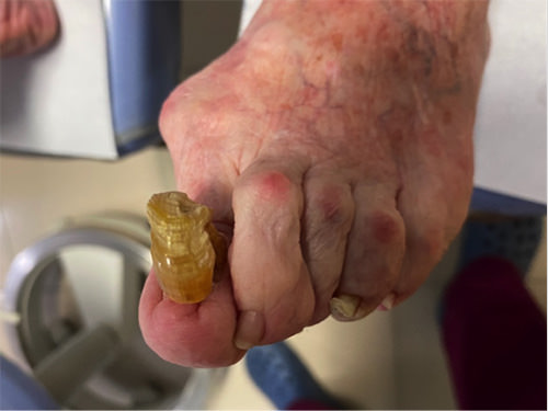 5 Diabetes uñas