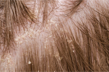 5 Manejo dermatitis seborreica