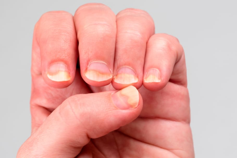 6 Diabetes uñas