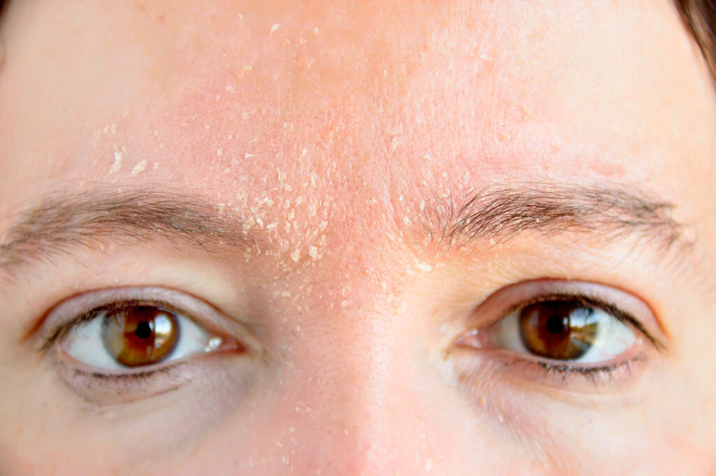 6 Manejo dermatitis seborreica