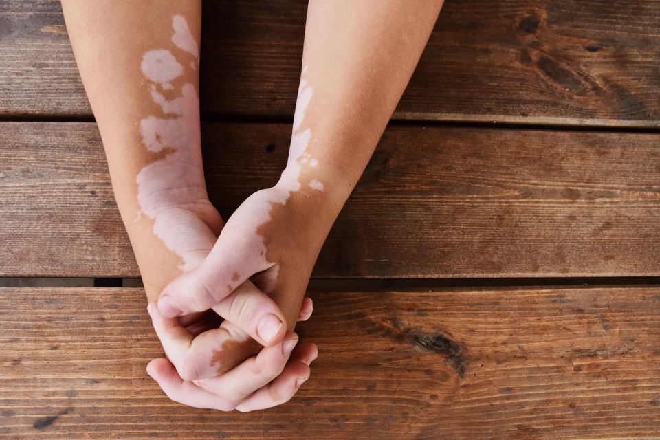 6 Vitiligo enfermedades cardiovasculares