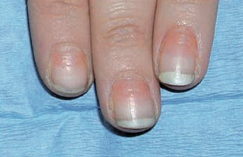 7 Diabetes uñas