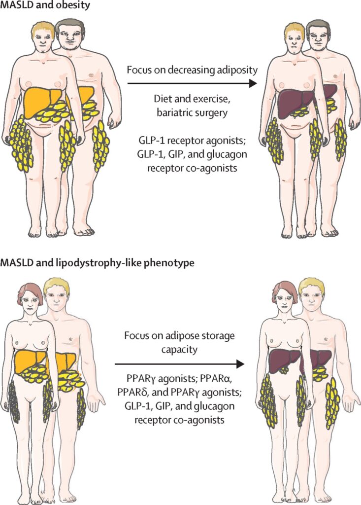 7 MASLD y diabetes