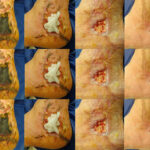 10 Desbridamiento heridas fases