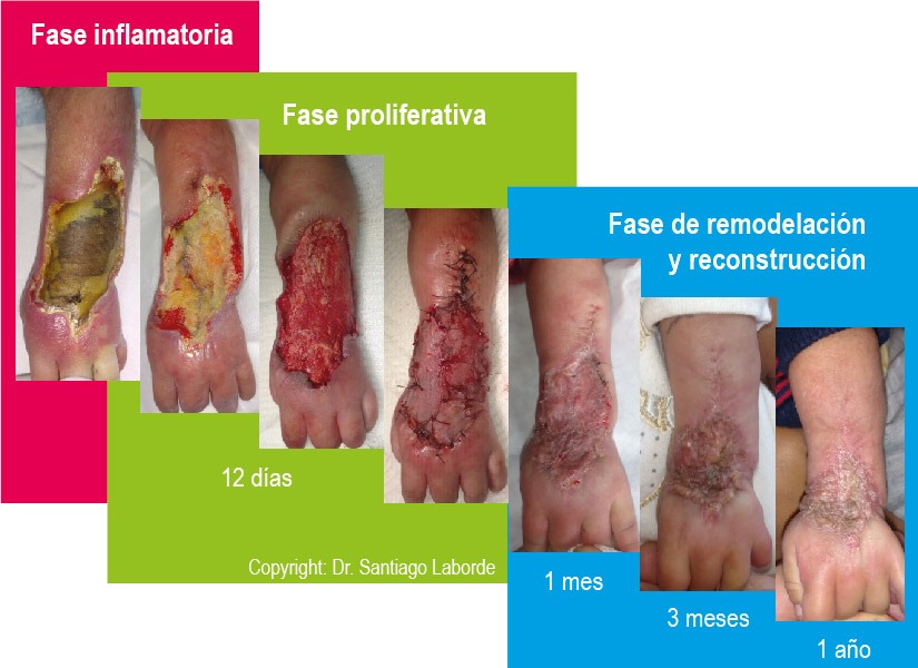 5 Desbridamiento heridas fases