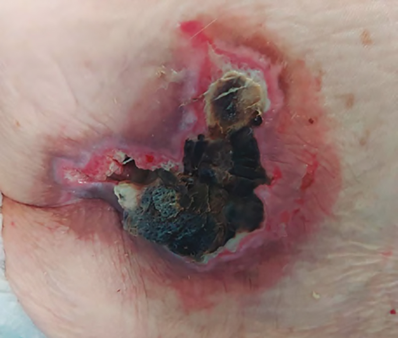 desbridamiento heridas indicaciones 4