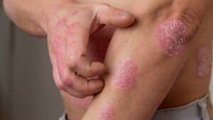 0 Tratamiento tópico psoriasis