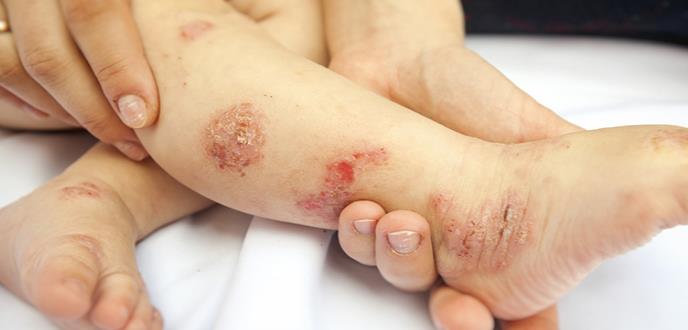 1 Dermatitis atópica terapia sistémica