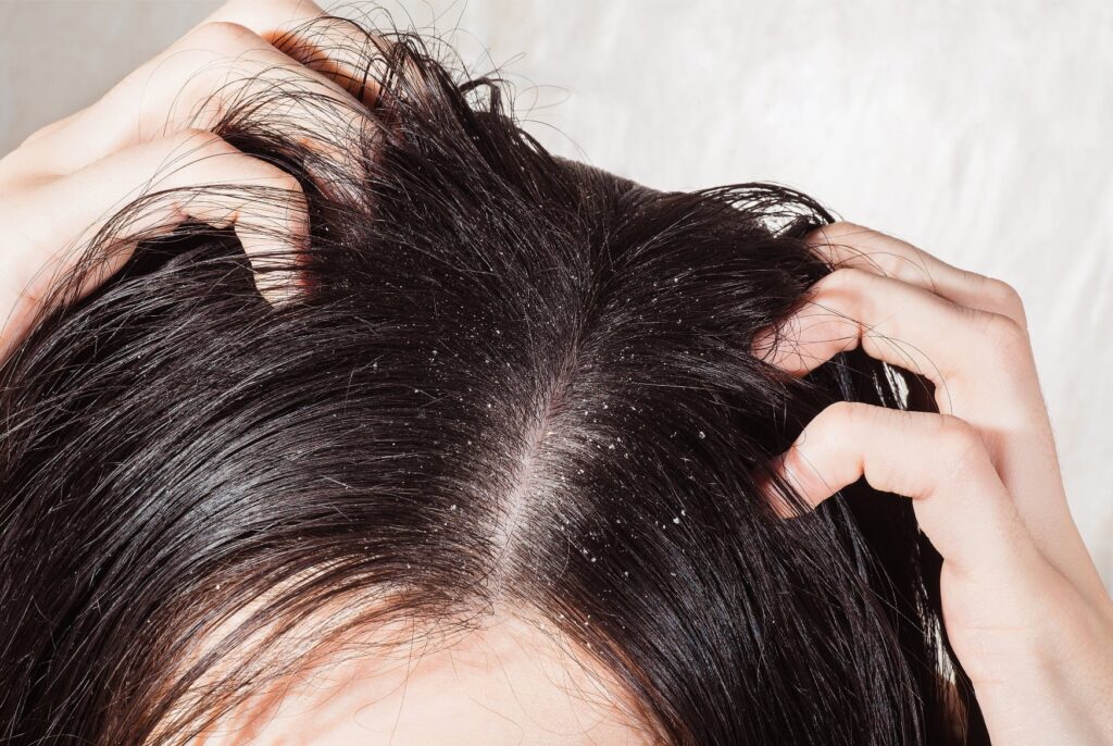2 Tratamiento dermatitis seborreica