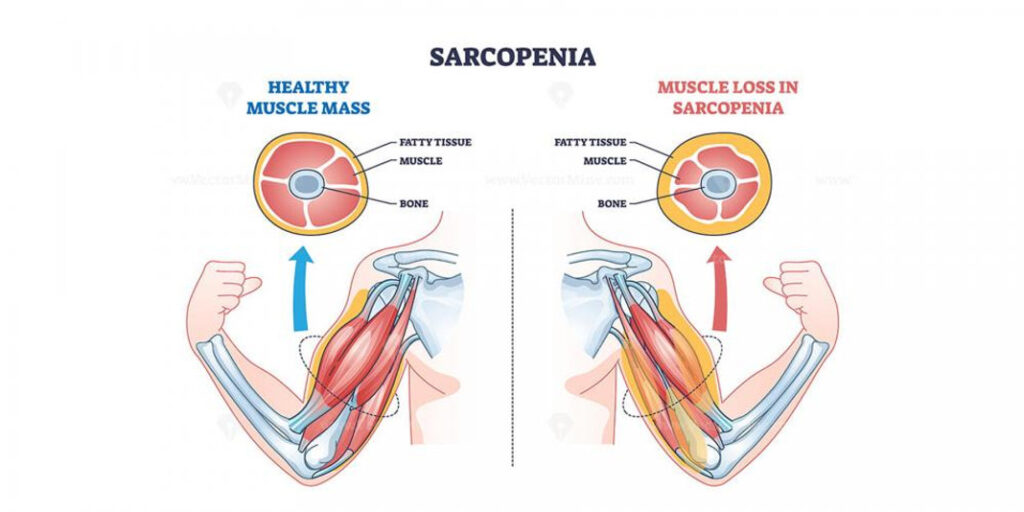 3 Diabetes sarcopenia