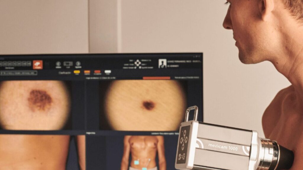 3 Melanoma tecnologías imagen