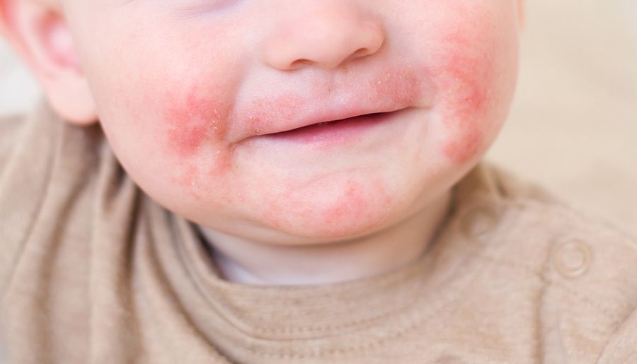4 Dermatitis atópica terapia sistémica