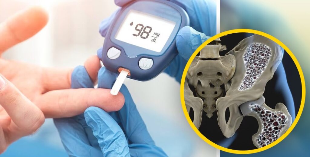 4 Diabetes salud ósea