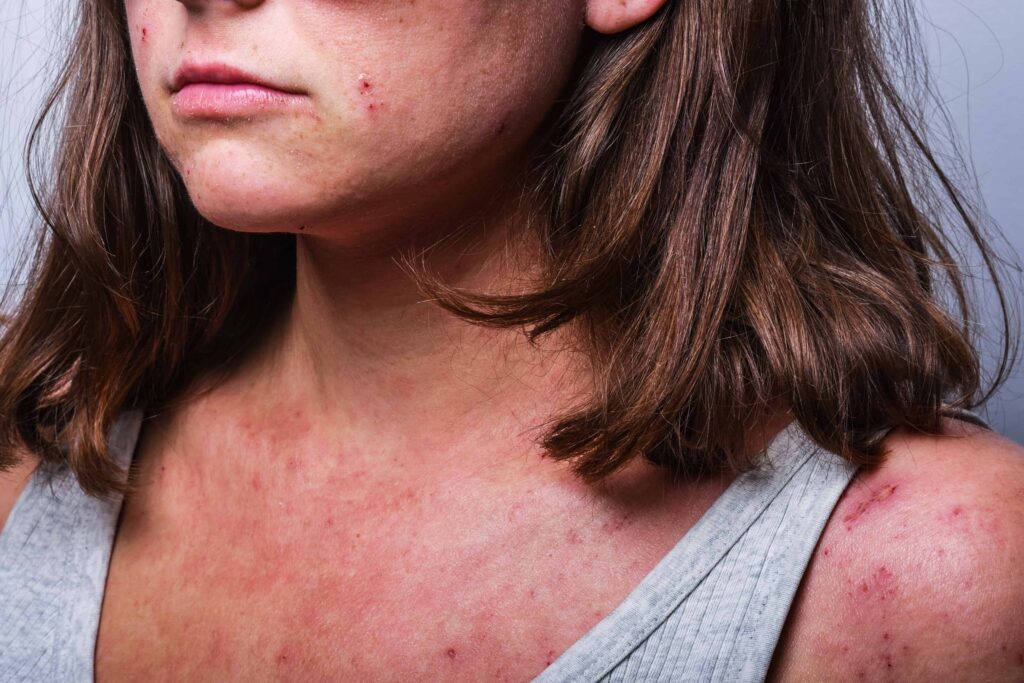 5 Dermatitis atópica terapia sistémica