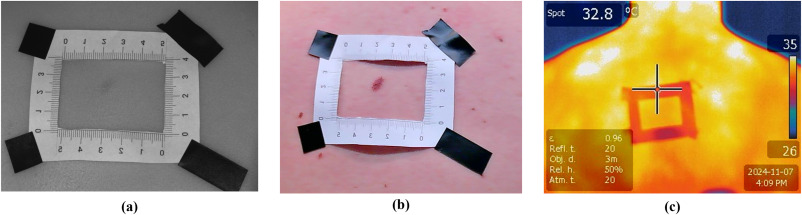 5 Melanoma tecnologías imagen