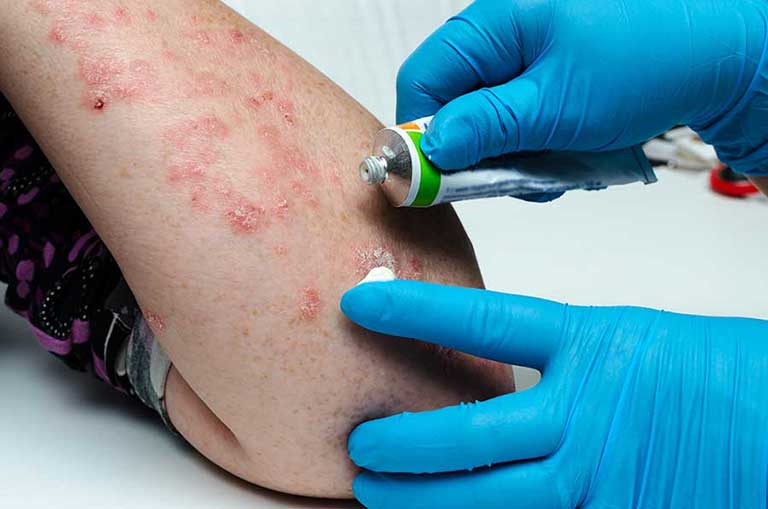 5 Tratamiento tópico psoriasis