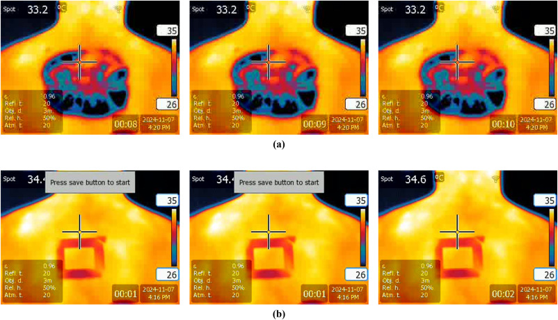 6 Melanoma tecnologías imagen