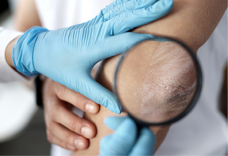 6 Tratamiento tópico psoriasis