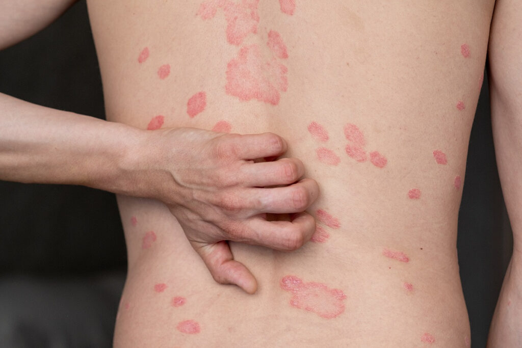 0 Psoriasis cáncer