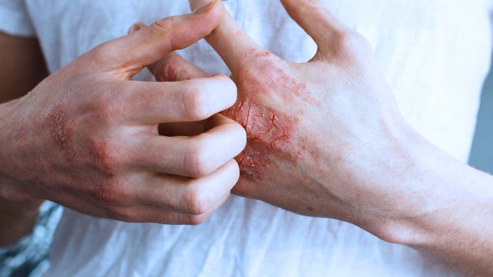 1 Dermatitis atópica riesgo metabólico