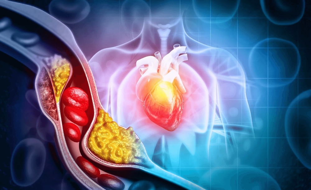 1 Diabetes infarto