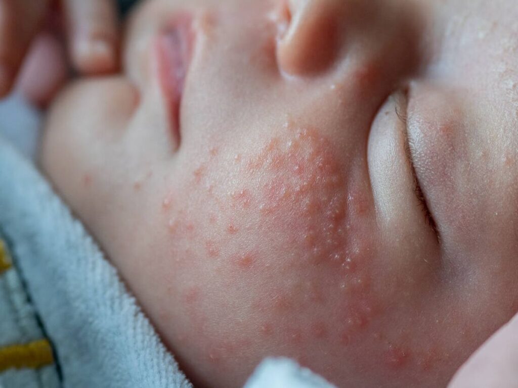 2 Día Mundial Dermatitis Atópica 2025