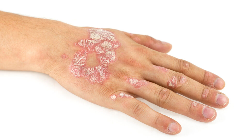 2 Psoriasis cáncer
