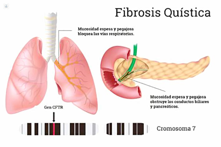 3 Diabetes fibrosis quística.jpg