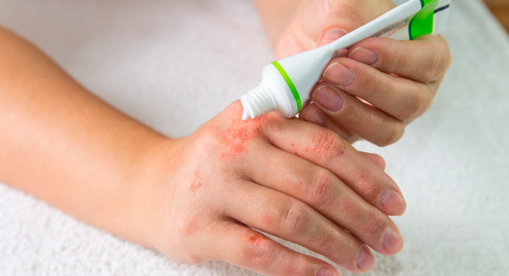 4 Día Mundial Dermatitis Atópica 2025