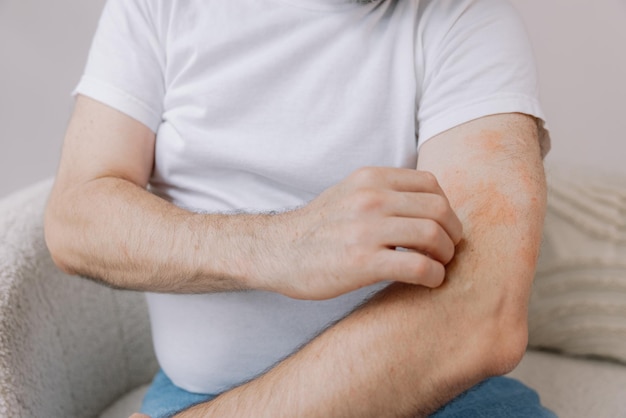 5 Dermatitis atópica obesidad