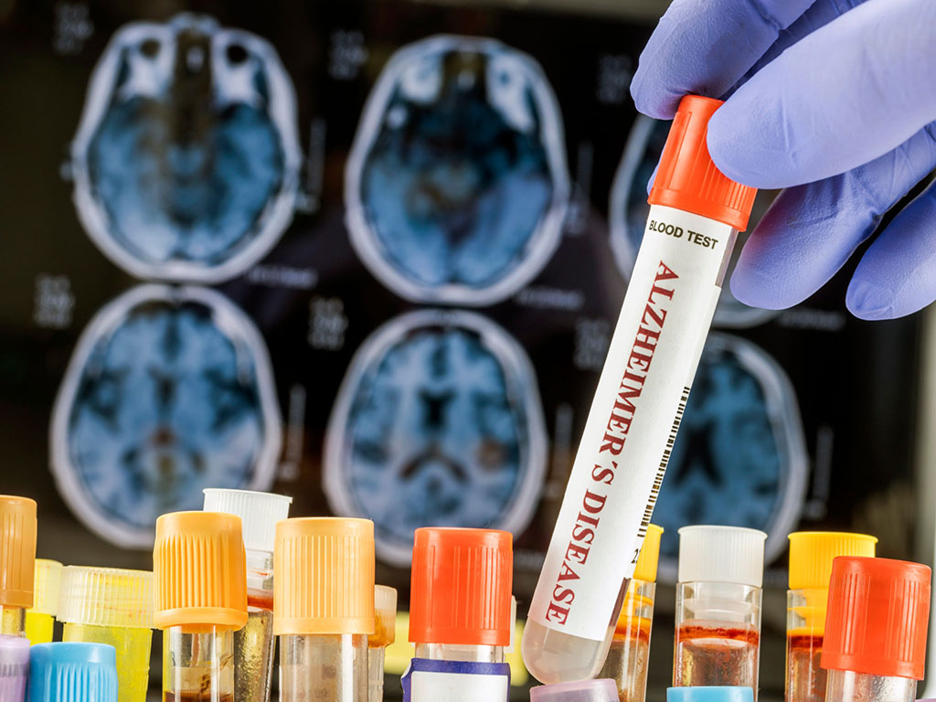5 Diabetes enfermedad de Alzheimer