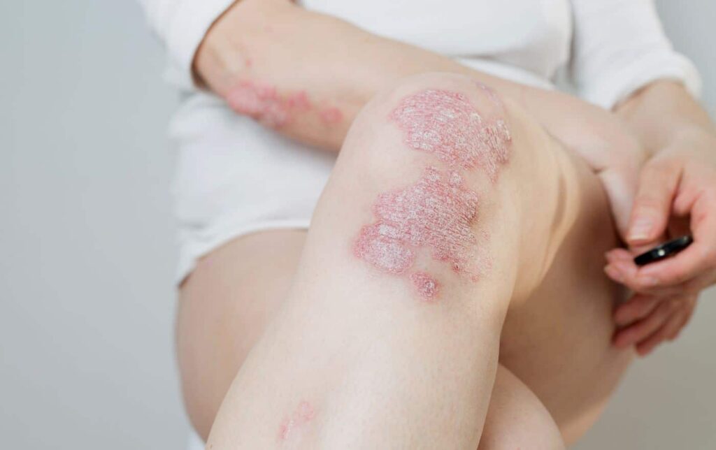 5 Psoriasis fertilidad femenina
