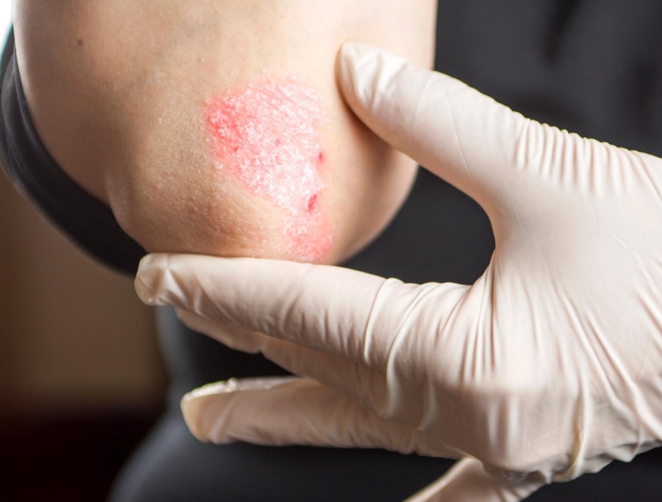 5 Psoriasis cáncer