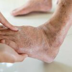 0 Diabetes complicaciones piel