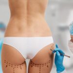0 acido hialuronico gluteos